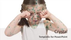  Presentation with sick baby - Audience pleasing slide deck consisting of baby poor - sick child chickenpox isolated backdrop and a  colored foreground