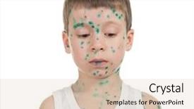 Presentation with sick child - Colorful PPT theme enhanced with baby poor - sick child chickenpox isolated backdrop and a  colored foreground