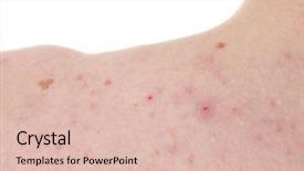  Presentation with acne - Slide set consisting of making tattoo on woman lumbar background and a light blue colored foreground