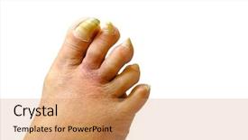  Presentation with nails - Slide deck with toenail fungus - sick unhealthy nails background and a coral colored foreground