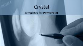  Presentation with fracture bone - Amazing PPT theme having bone fracture - pen showing x-ray picture backdrop and a light blue colored foreground