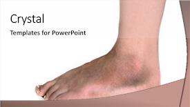  Presentation with broken bone - Slides with bone fracture - woman with swollen broken foot background and a white colored foreground