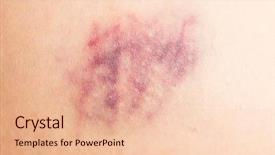  Presentation with wound - Slides enhanced with bruise on wounded woman leg background and a lemonade colored foreground