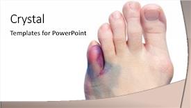  Presentation with break up broken heart - Colorful theme enhanced with bruises bunions and broken toes backdrop and a white colored foreground