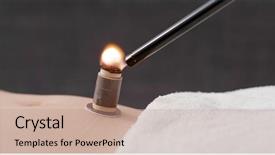  Presentation with traditional chinese medicine - Cool new PPT theme with burn patients - chinese traditional medicine moxibustion therapy backdrop and a  colored foreground