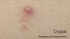  Presentation with skin - Slide set featuring carbuncle - pimple extreme on human skin background and a coral colored foreground