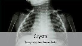  Presentation with chest - PPT theme having chest x-ray of young background and a light gray colored foreground