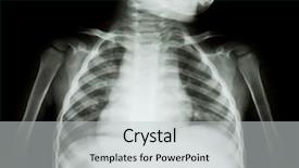  Presentation with chest - Audience pleasing PPT theme consisting of chest x-ray of young backdrop and a light gray colored foreground