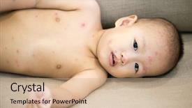  Presentation with old photo - PPT layouts consisting of red spots of chickenpox background and a coral colored foreground