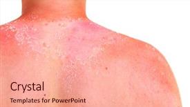  Presentation with child cancer - Presentation enhanced with childhood cancer - sunburn on a child's back background and a coral colored foreground