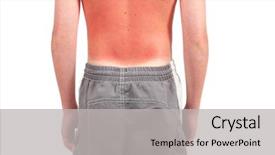 Presentation with child cancer - Cool new presentation theme with childhood cancer - sunburn on a child's back backdrop and a light gray colored foreground