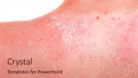  Presentation with childhood cancer - PPT theme having childhood cancer - sunburn on a teen's back background and a coral colored foreground