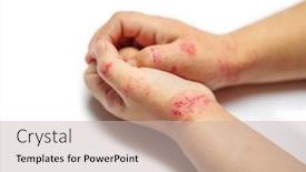  Presentation with dermatitis - PPT layouts with children-hand-with-dermatitis-eczema background and a soft green colored foreground