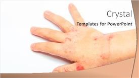  Presentation with dermatitis - Colorful slide deck enhanced with children-hand-with-dermatitis-eczema backdrop and a sky blue colored foreground