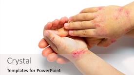  Presentation with dermatitis - Theme having children-hand-with-dermatitis-eczema background and a lemonade colored foreground
