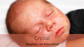  Presentation with dermatitis - PPT theme consisting of closeup-of-baby-face-skin background and a coral colored foreground
