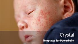  Presentation with dermatitis - Presentation theme having closeup-of-baby-face-skin background and a navy blue colored foreground