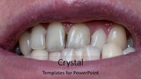  Presentation with plaque - Theme enhanced with closeup of dental plaque background and a coral colored foreground