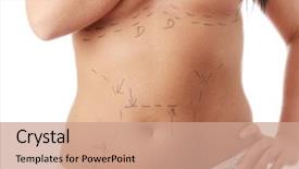  Presentation with cosmetic surgery - Slides with boy meets girl beautiful young woman lying naked on bed background and a light gray colored foreground