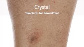  Presentation with allergic rhinitis - PPT theme featuring cold urticaria allergic on leg background and a coral colored foreground