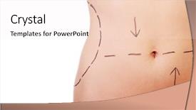  Presentation with surgery - Beautiful slide set featuring contour - woman belly marked out fo backdrop and a sky blue colored foreground