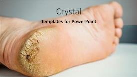  Presentation with cracked - Colorful slide deck enhanced with cracked-callosity-male-heel-close backdrop and a lemonade colored foreground