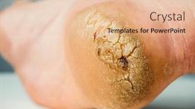  Presentation with cracked - Theme having cracked-callosity-male-heel-close background and a lemonade colored foreground