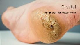  Presentation with cracked - Audience pleasing presentation consisting of cracked-callosity-male-heel-close backdrop and a lemonade colored foreground