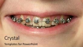  Presentation with teeth - Cool new slides with dental braces on teeth backdrop and a coral colored foreground