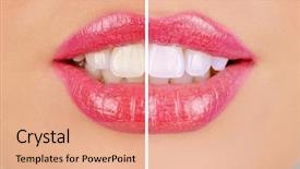  Presentation with teeth whitening - Presentation design featuring dental tools - woman teeth background and a coral colored foreground