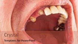  Presentation with dentistry - Presentation theme consisting of dentistry-missing-row-of-teeth background and a red colored foreground