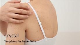  Presentation with allergy - Cool new PPT layouts with dermatitis - allergy concept woman scratching her backdrop and a coral colored foreground