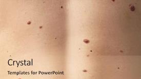  Presentation with dermatology - PPT layouts featuring dermatology cancer - young man with birthmarks closeup background and a lemonade colored foreground