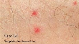  Presentation with mosquito - Slides having detail of mosquito spot allergy on mature man skin background and a coral colored foreground