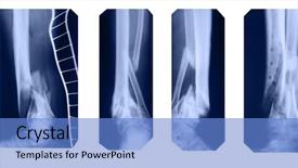  Presentation with disease - PPT theme having disease prognosis - fractured legs collection background and a teal colored foreground