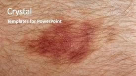  Presentation with skin - Presentation enhanced with tissue disorders - nasty looking bruise on man's background and a  colored foreground