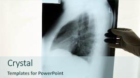 Presentation with chest - Beautiful presentation theme featuring doctor examins an x-ray backdrop and a light blue colored foreground
