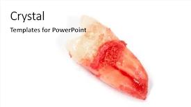  Presentation with dental extraction - Beautiful theme featuring beautiful bride wearing white wedding dress with flowers on her head backdrop and a light gray colored foreground