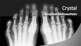  Presentation with fingers - Amazing presentation design having fingers exposed on x-ray backdrop and a dark gray colored foreground