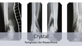  Presentation with fracture bone - PPT theme enhanced with fractured legs collection background and a light gray colored foreground