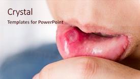  Presentation with fungal infection - Amazing theme having fungal infection - mouth aphtha backdrop and a lemonade colored foreground