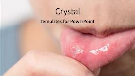  Presentation with woman in labor - PPT theme featuring fungal infection - woman suffer from aphthous stomatitis background and a lemonade colored foreground