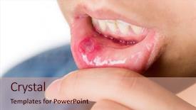  Presentation with fungal infection - PPT theme enhanced with fungal infection - woman suffer from mouth aphtha background and a lemonade colored foreground