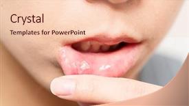  Presentation with fungal infection - Slide deck consisting of fungal infection - woman suffer from mouth aphtha background and a lemonade colored foreground