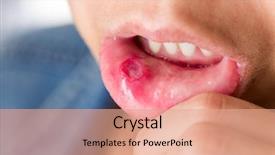  Presentation with fungal infection - Colorful presentation theme enhanced with fungal infection - woman with aphtha backdrop and a coral colored foreground