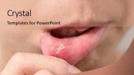  Presentation with fungal infection - Colorful theme enhanced with fungal infection - woman with aphthae on lip backdrop and a coral colored foreground