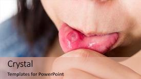  Presentation with fungal infection - Theme consisting of fungal infection - woman with aphthous stomatitis background and a coral colored foreground