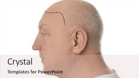  Presentation with hair loss - PPT theme featuring hair loss concept bald senior background and a soft green colored foreground