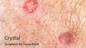  Presentation with scars - Audience pleasing PPT theme consisting of hand scars from skin cryotherapy backdrop and a coral colored foreground