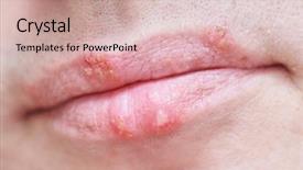  Presentation with virus infection - PPT theme consisting of hsv - herpes simplex virus infection background and a coral colored foreground